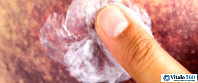 Bruises Popping Up Easily? Let’s Uncover Why!