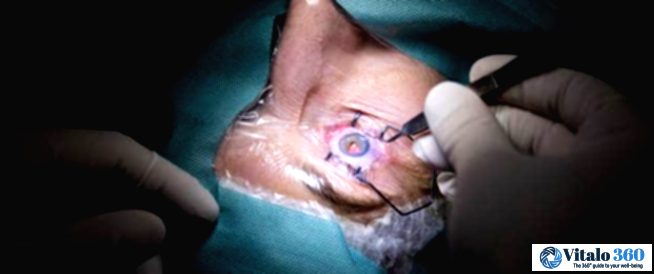 Considering Eyelid Surgery? Don’t Skip These Crucial Tests!