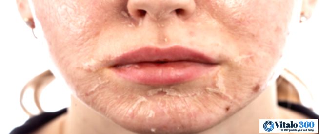 Unlock Your Best Skin: Medical vs. At-Home Peels - What's the Difference? Unlock Your Best Skin: Medical vs. At-Home Peels – What’s the Difference?