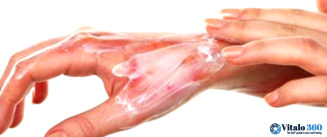 Understanding Burn Severity and First Aid