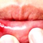 Say Goodbye to Oral Thrush: Simple Treatment Options