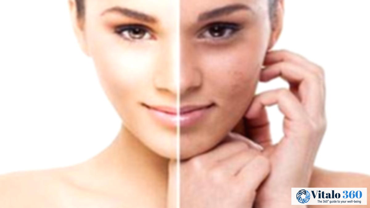 10 Amazing Home Remedies for Melasma Treatment