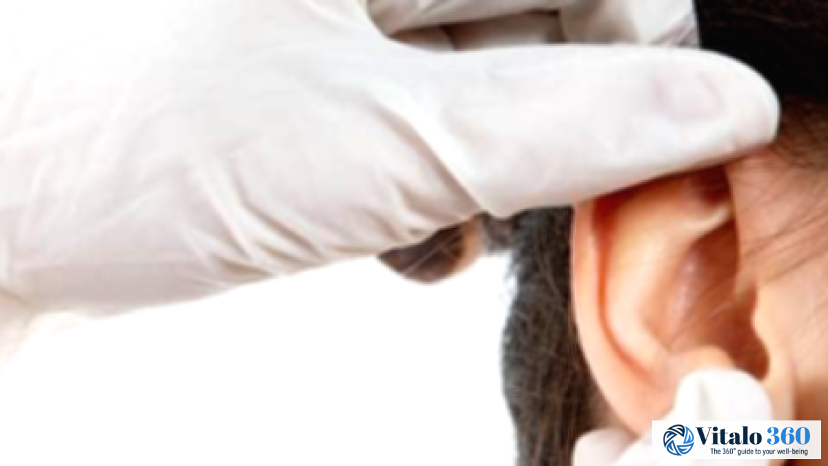 Cauliflower Ear: Key Facts You Should Know