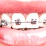 Cleaning Teeth with Braces: A Simple & Effective Guide
