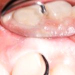 Gum Disease: Your Guide to Understanding & Prevention