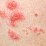 Shingles: Symptoms, Causes, and Effective Treatments Shingles: Symptoms, Causes, and Effective Treatments