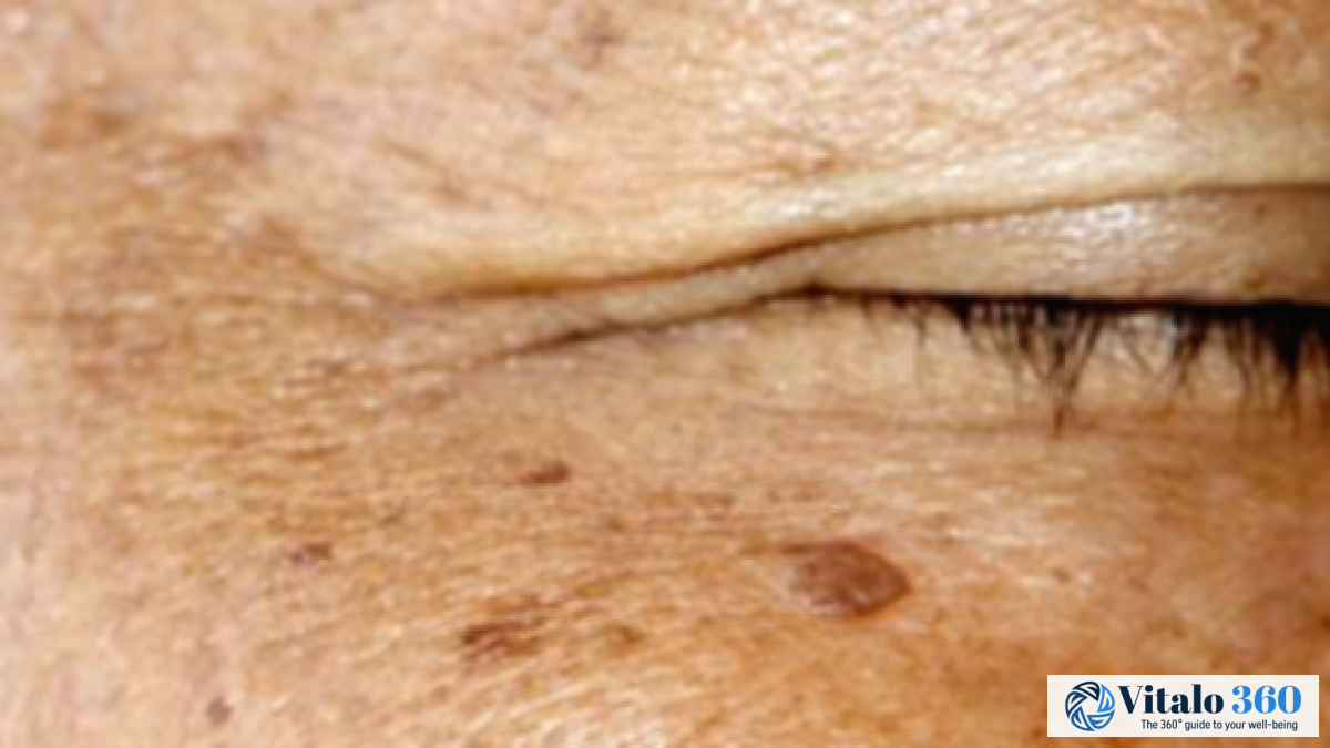 Treating Skin Pigmentation: Key Methods Explained