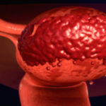 10 Key Questions to Ask Your Doctor About Endometriosis