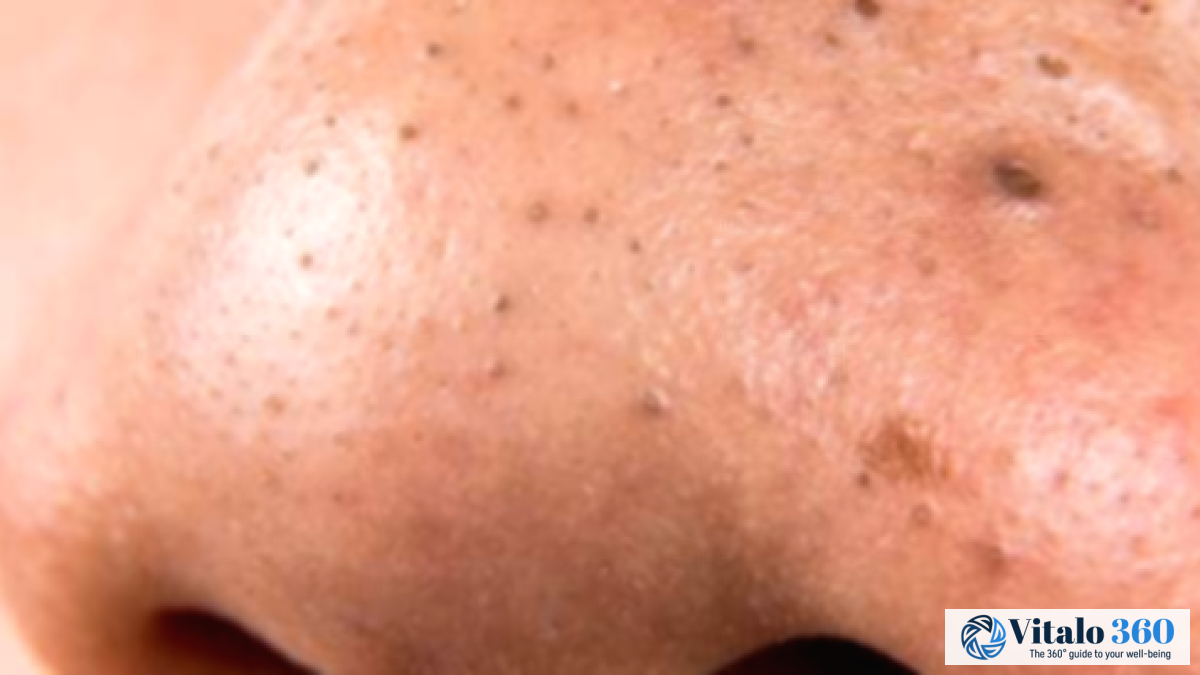 6 Effective Ways to Get Rid of Blackheads 6 Effective Ways to Get Rid of Blackheads