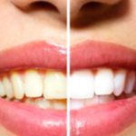 6 Simple Home Remedies for Whiter, Brighter Teeth