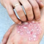 8 Ways to Control Psoriasis Spread on Your Body