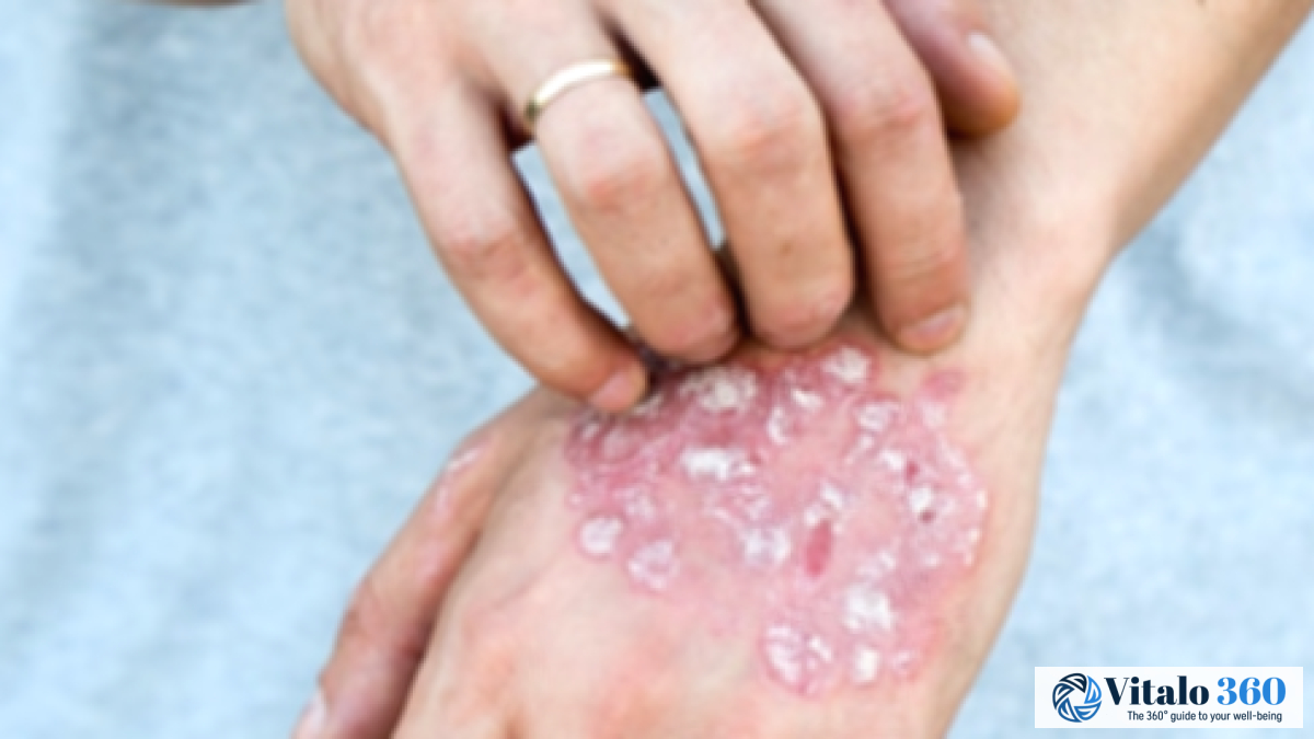8 Ways to Control Psoriasis Spread on Your Body