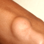 Benign Tumors: A Comprehensive Guide