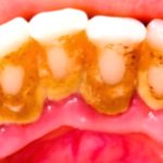 Black Teeth: Causes & Simple Home Remedies