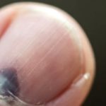 Black Toenail: Causes, Symptoms, and Effective Treatments Black Toenail: Causes, Symptoms, and Effective Treatments