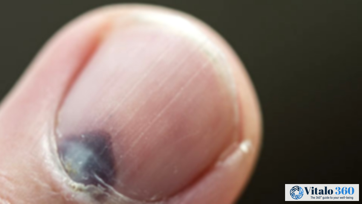 Black Toenail: Causes, Symptoms, and Effective Treatments