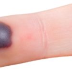 Blood Blisters: Symptoms, Causes, and Treatment Options Blood Blisters: Symptoms, Causes, and Treatment Options