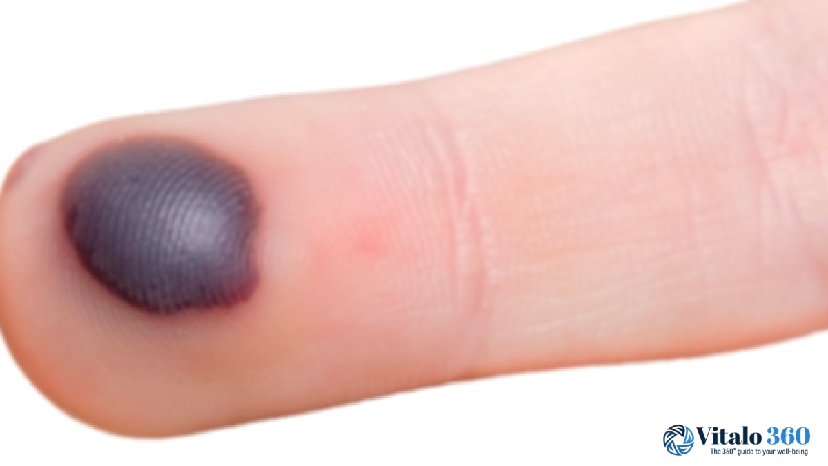 Blood Blisters: Symptoms, Causes, and Treatment Options