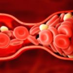 Blood Clots: Where They Can Occur, Explained Blood Clots: Where They Can Occur, Explained