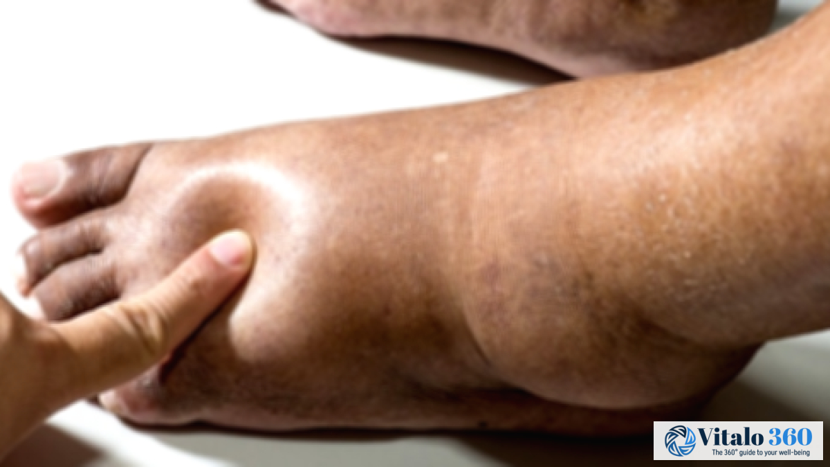 Body Fluid Retention: Causes, Symptoms & Tips