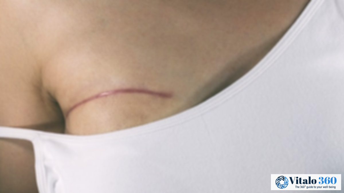 Breast Reconstruction After Mastectomy: What to Expect