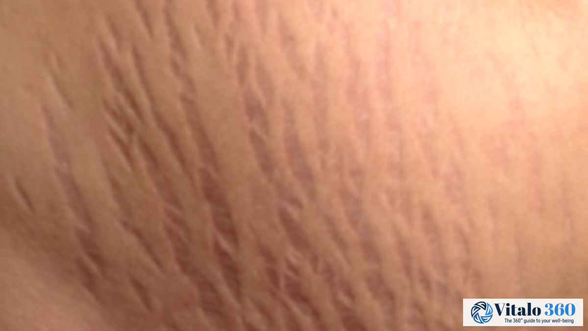 Breast Stretch Marks: Causes, Prevention & Care