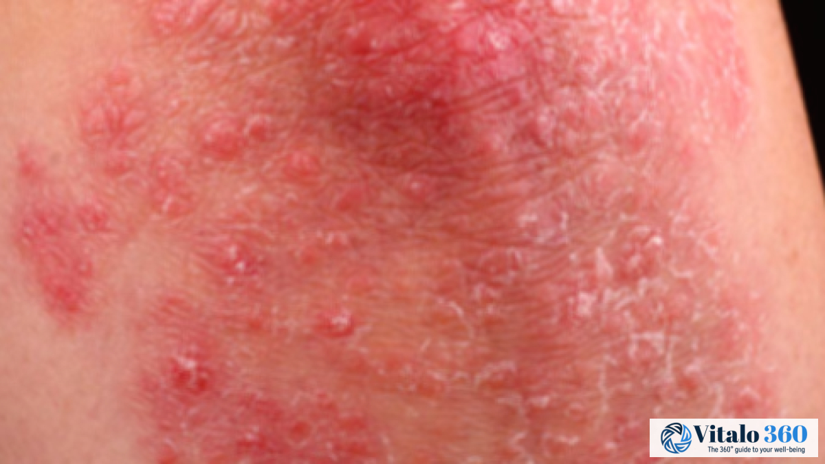 Chicken Skin: Causes, Symptoms, and Treatment