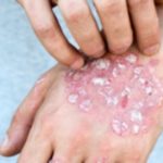 Eczema Relief at Home: Effective Treatment Options