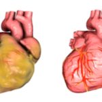 Enlarged Heart: Your Complete Guide