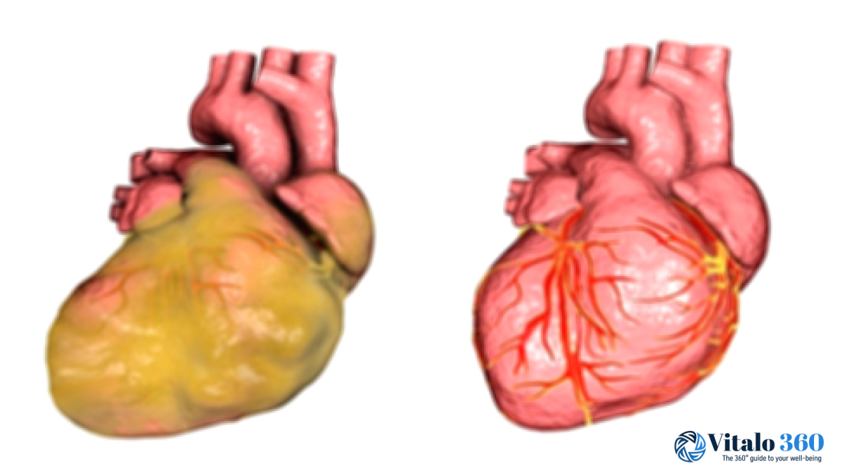 Enlarged Heart: Your Complete Guide Enlarged Heart: Your Complete Guide