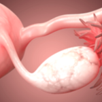 Fallopian Tube Blockage: What You Need to Know