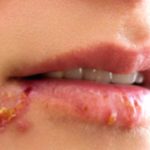 Fever Pills: Causes, Treatment, and Relief Options Fever Pills: Causes, Treatment, and Relief Options