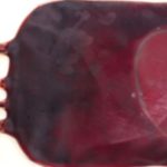 Fluid Overload: What You Need to Know About Hypervolemia