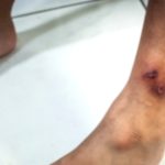 Gangrene, Diabetes, and Other Diseases: The Connection Gangrene, Diabetes, and Other Diseases: The Connection