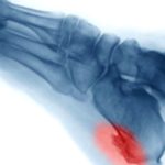 Heel Spurs: Key Facts You Should Know Heel Spurs: Key Facts You Should Know