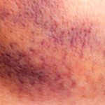 Internal Bleeding: Key Info, Symptoms & What to Do Internal Bleeding: Key Info, Symptoms & What to Do