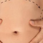 Liposuction: Your Complete Guide To The Procedure Liposuction: Your Complete Guide To The Procedure