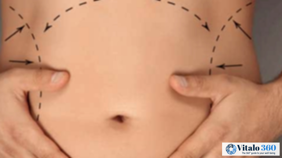 Liposuction: Your Complete Guide To The Procedure Liposuction: Your Complete Guide To The Procedure