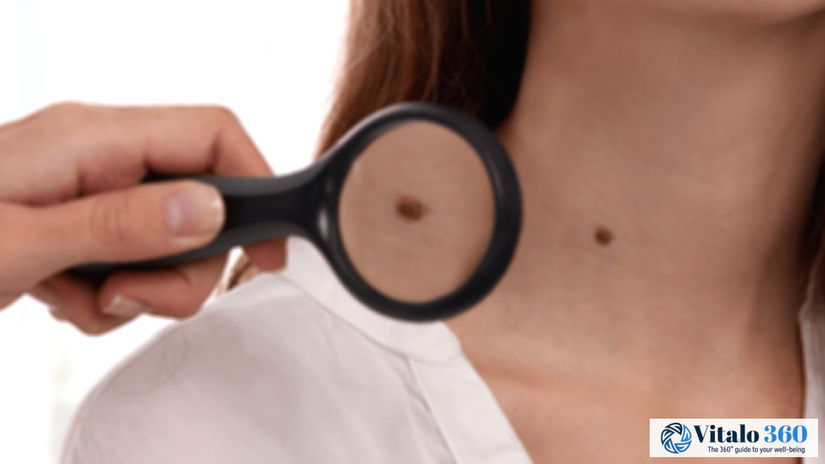 Mole Guide: Understanding Causes, Risks & Removal
