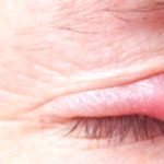 Natural Home Remedies to Soothe Your Stye