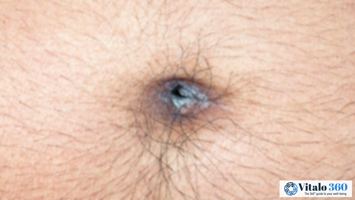 Navel Discharge: Causes, Symptoms, and Treatment