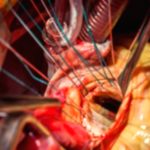 Open-Heart Surgery: A Comprehensive Guide Open-Heart Surgery: A Comprehensive Guide