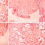 Psoriasis: Interesting Facts You Should Know Psoriasis: Interesting Facts You Should Know