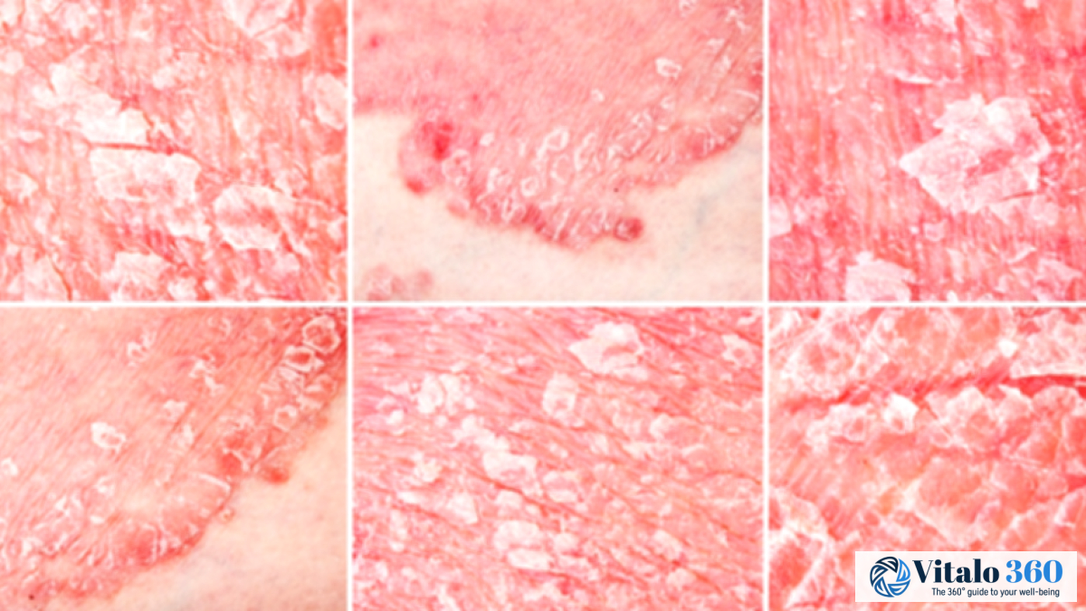 Psoriasis: Interesting Facts You Should Know