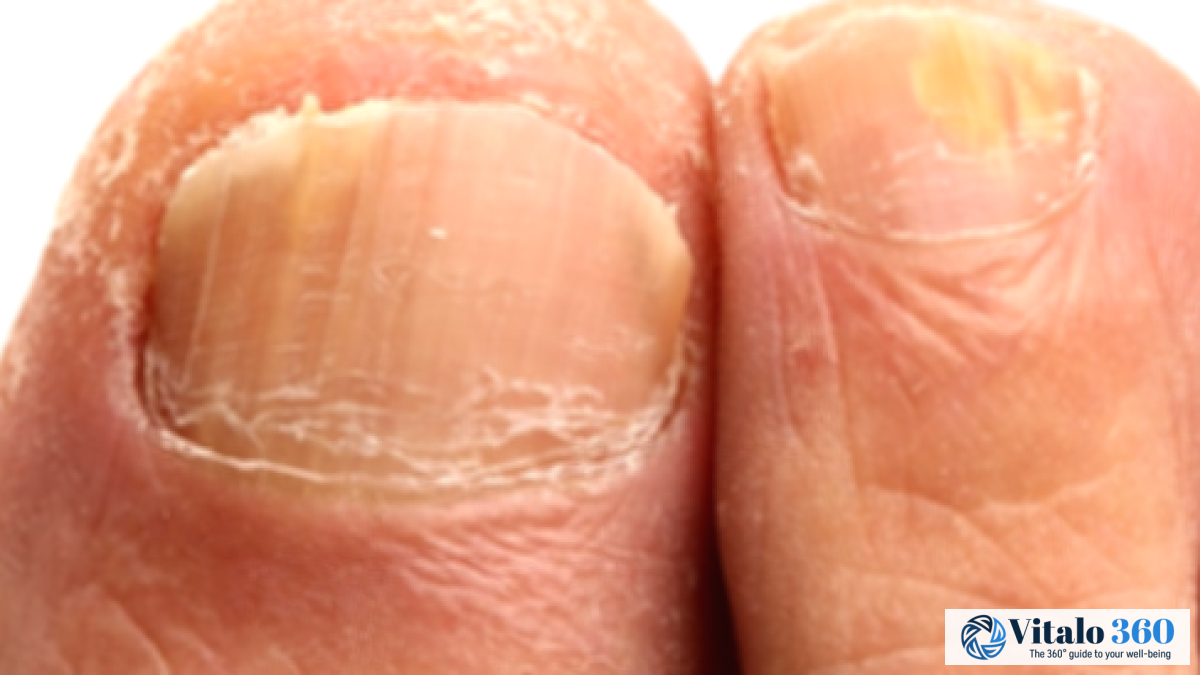 Thick Nails: Causes and Effective Treatment Options