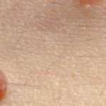 Third Nipple: Is Having One Normal? A Quick Guide Third Nipple: Is Having One Normal? A Quick Guide