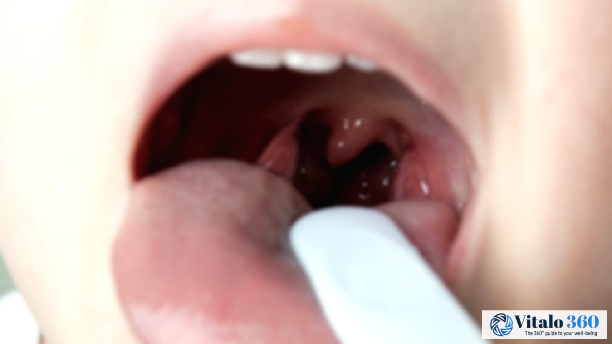 Tonsillitis Guide: Symptoms, Causes, & Treatment Options