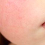 Fifth Disease: Symptoms, Causes & Treatment Info fifth disease symptoms causes treatment info