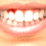 Bleeding Gums: Uncover the Causes and Solutions Bleeding Gums: Uncover the Causes and Solutions