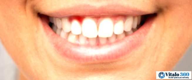 Bleeding Gums: Uncover the Causes and Solutions